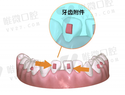 全冠作龈下边缘设计的优缺点（前牙全冠修复作龈下边缘的优点是）(图1)